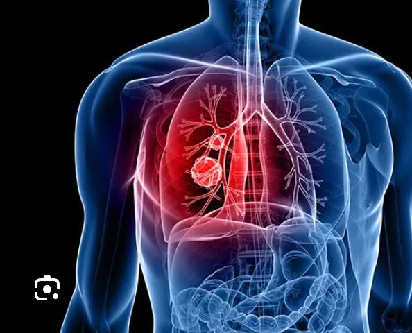 Umurwayi wo muri Australia yahinduriwe ibihaha hifashishijwe ikorana buhanga rya Ai mugihe kingana n'amasaha 48 icyo gikorwa kiri gikorwa  